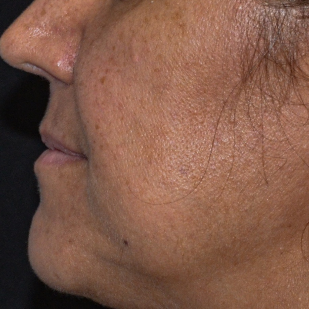 Caso _7_Antes